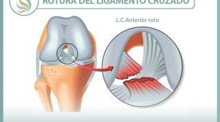 Rotura del ligamento cruzado de la rodilla, información consejos y un útil vídeo sobre el tema