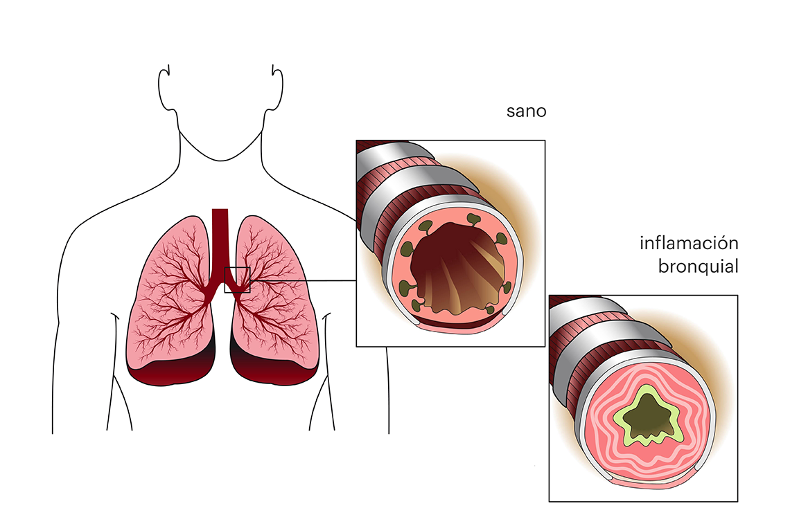 Sistema respiratorio sano y con asma